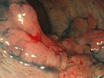 回盲弁に進展する大腸癌（LST-NG）