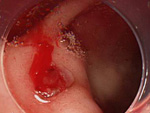 Hemorrhagic Duodenal Ulcer