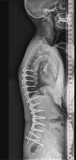腰部脊柱管狭窄症 術後側面