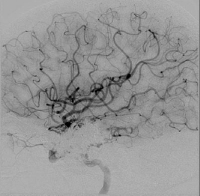 オニキス塞栓術で治療後の脳血管撮影。動静脈奇形が消えている。
