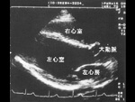 Echocardiogram (Ultrasound)