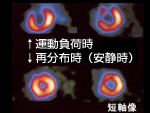 Nuclear Cardiology Examination (Scintigraphy)
