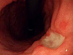 潰瘍を合併する早期胃癌