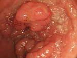 広範な直腸癌（粗大結節を有するLST-G）