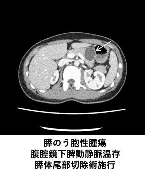 膵のう胞性腫瘍
