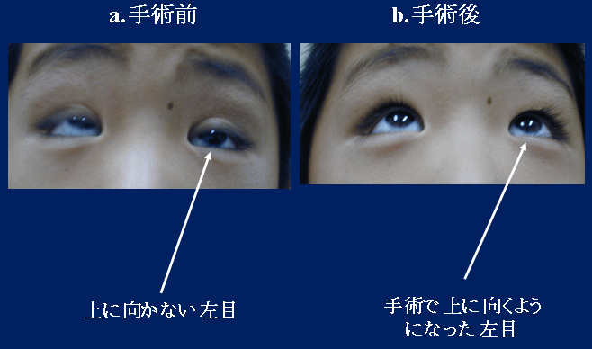 写真：手術前後の目の動き