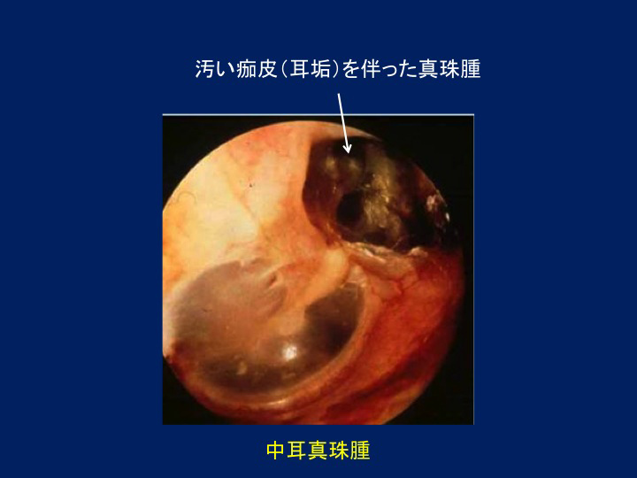 写真：中耳真珠腫の術前後の比較
