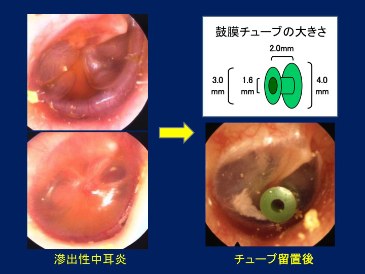 写真：滲出性中耳炎の術前後の比較