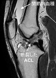 膝前十字靭帯損傷の診断と治療 整形外科 受診案内 聖路加国際病院