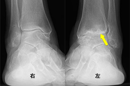 図1　左変形性足関節症：関節裂隙（骨と骨の隙間）が消失している。