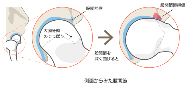 股関節唇損傷の診断と治療 整形外科 受診案内 聖路加国際病院