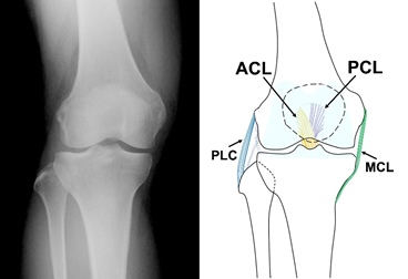 膝複合靭帯損傷の診断と治療 整形外科 受診案内 聖路加国際病院