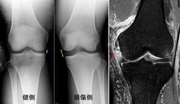 膝複合靭帯損傷の診断と治療 整形外科 受診案内 聖路加国際病院