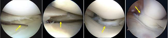 膝半月板損傷の診断と治療 整形外科 受診案内 聖路加国際病院
