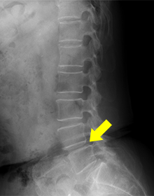 腰部脊柱管狭窄症 腰椎すべり症　術前