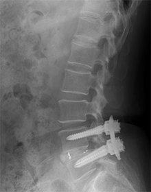 腰部脊柱管狭窄症 腰椎すべり症　術前