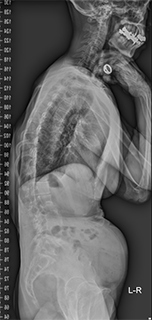 腰部脊柱管狭窄症 側弯症　術前側面