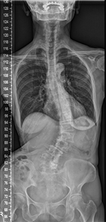 腰部脊柱管狭窄症 側弯症　術前正面