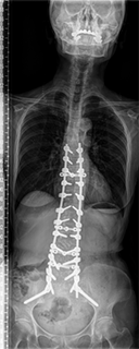 腰部脊柱管狭窄症 術後正面