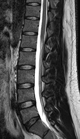 腰部脊柱管狭窄症の診断 正常患者のMRI