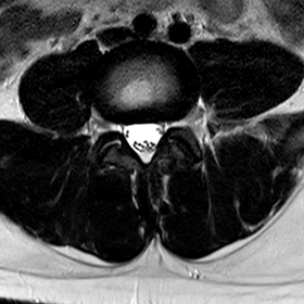 腰部脊柱管狭窄症の診断 正常患者のMRI