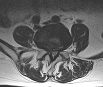 腰部脊柱管狭窄症の診断 脊柱管狭窄症のMRI