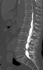 腰部脊柱管狭窄症の診断 脊髄造影CT