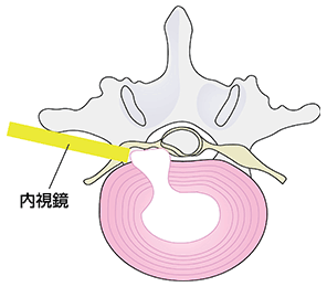 経皮的内視鏡下腰椎椎間板摘出術　PED