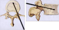 針は椎弓根を通過して椎体の前方に留置