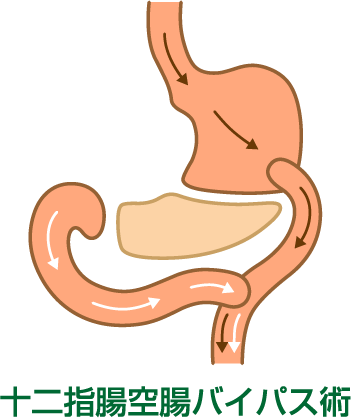 ④十二指腸空腸バイパス術