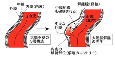 図3．大動脈解離の発生の様子 (模式図)