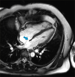 心房中隔欠損の心臓MRI／矢印：心房中隔の欠損