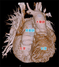 修正大血管転位症の心臓CT