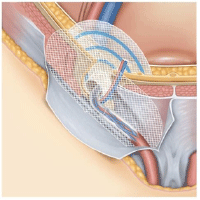 管 水腫 ヌック 女性の鼡径部ヘルニアの特徴